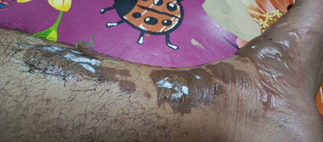 
					Luka Akibat Minyak Goreng Panas, Begini Langkah Pertolongan Pertamanya